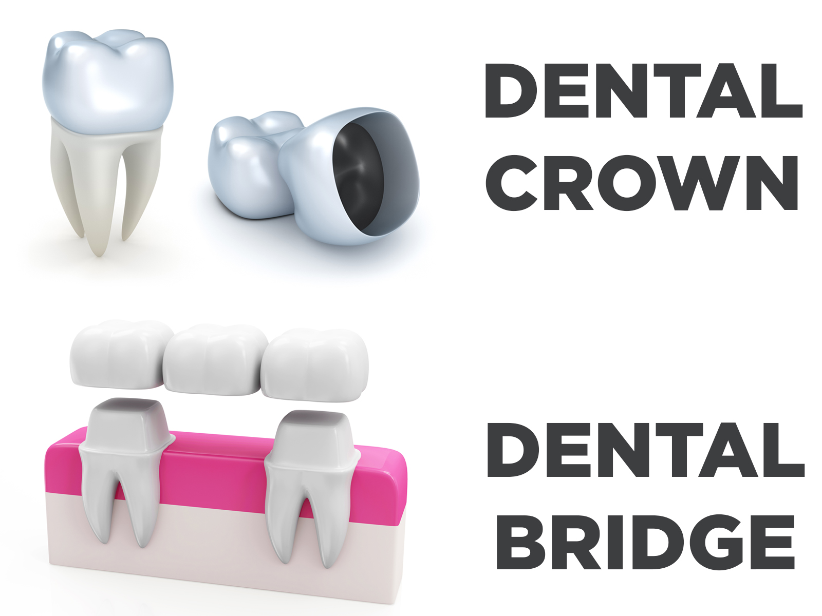 dental crown